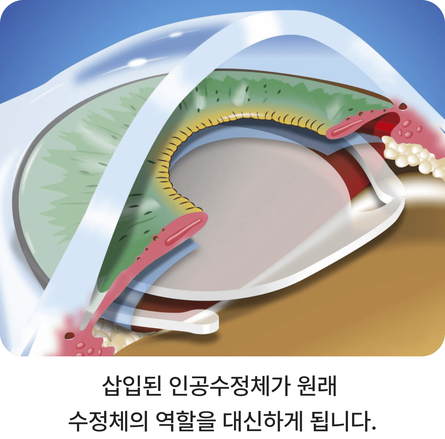 덕양구 노안백내장 수술, 가까운 글씨와 뿌연 시야가 함께 불편하다면